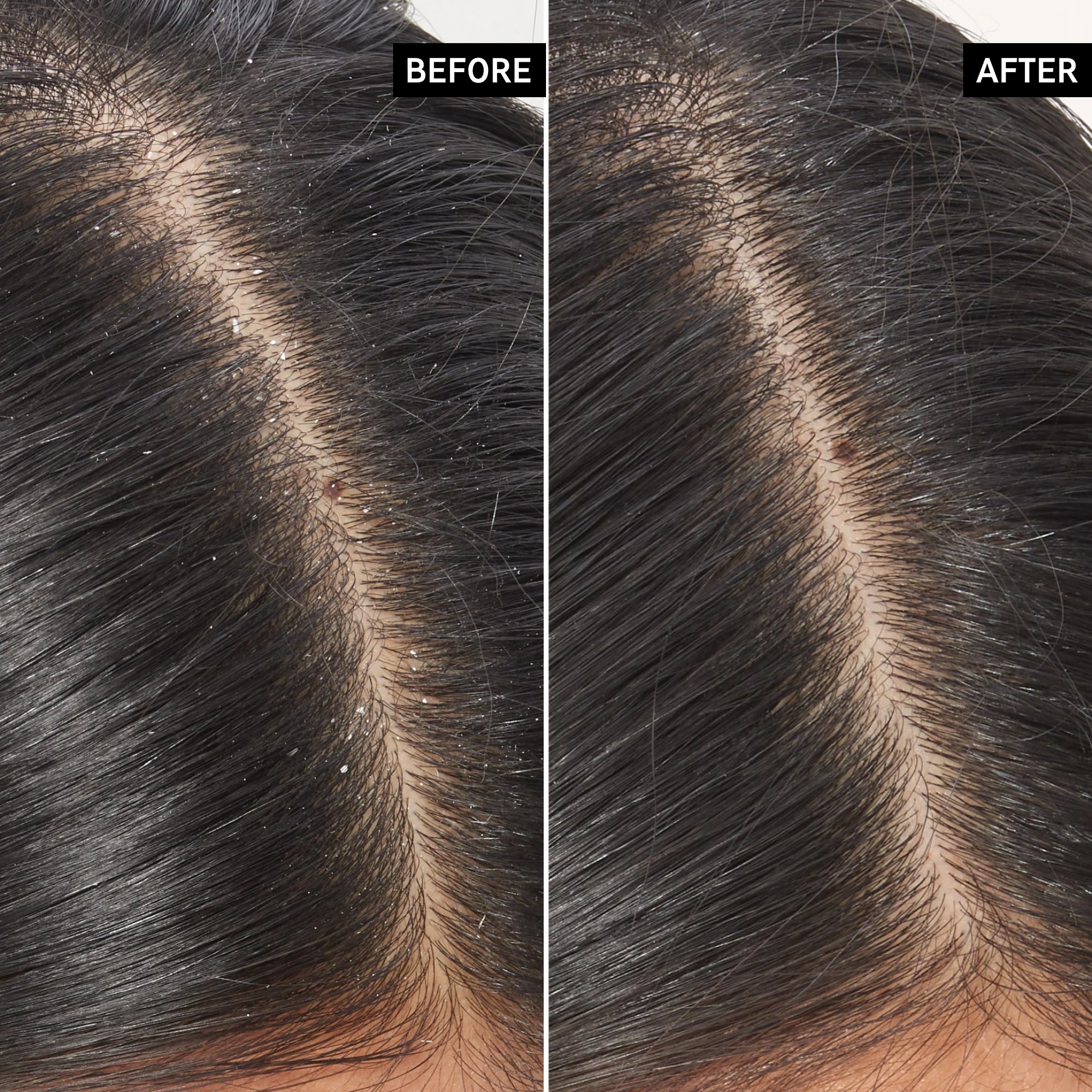 The Inkey List Salicylic Acid Exfoliating Scalp Treatment
