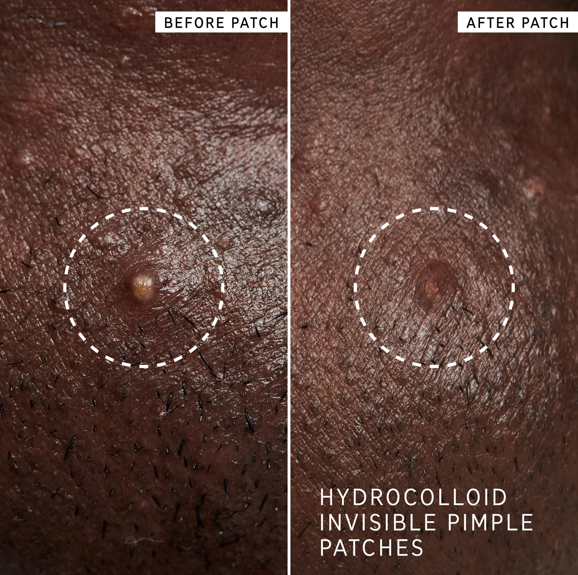 The Inkey List The Spot On Duo Set for blemish-prone skin
