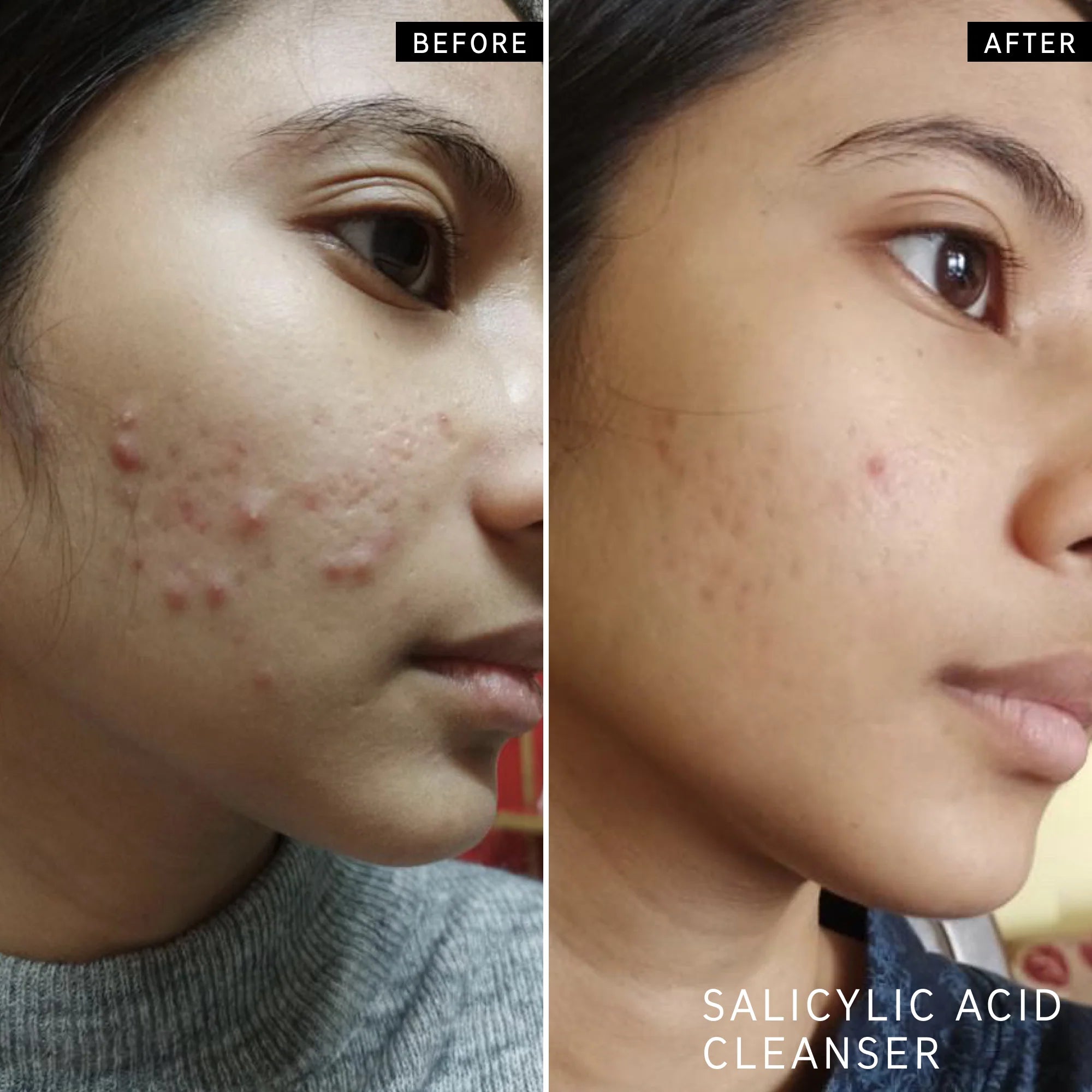 The Inkey List The Spot On Duo Set for blemish-prone skin