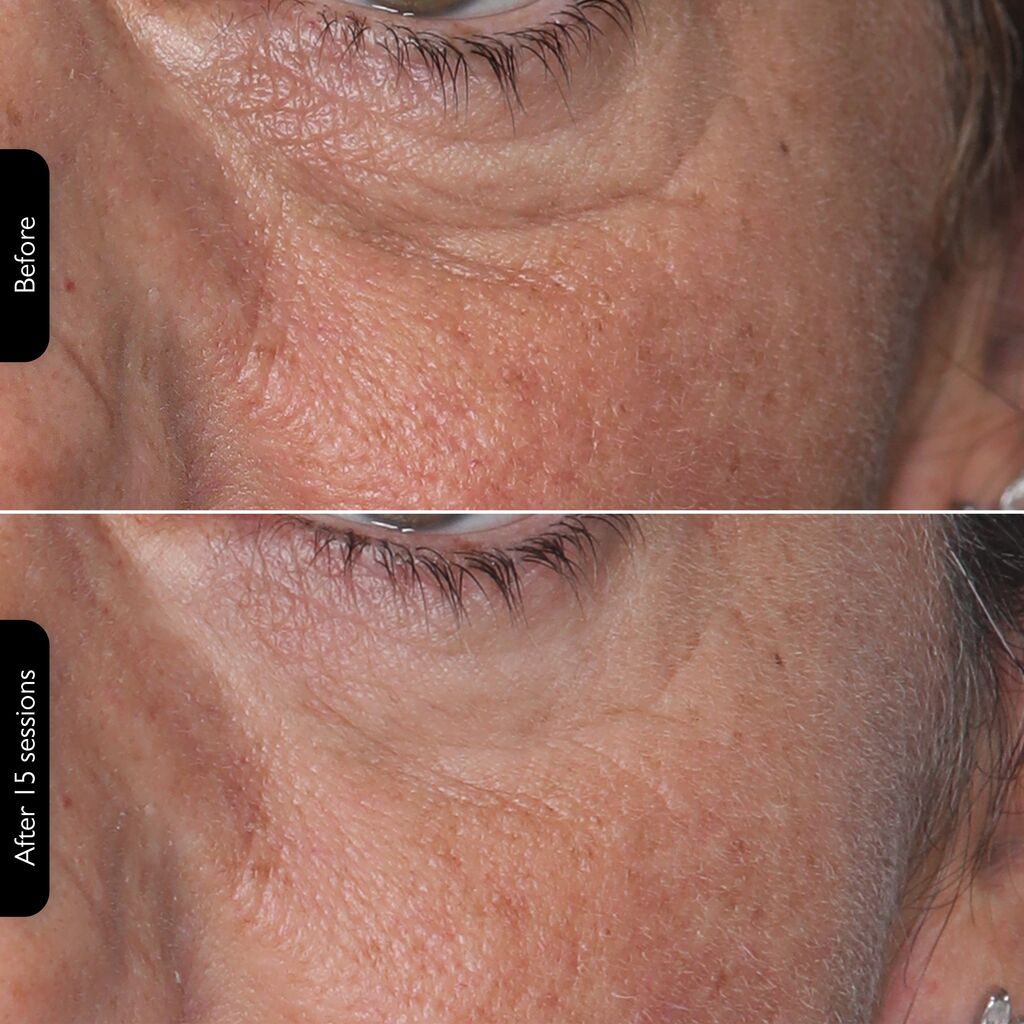 SILKN Facial LED Mask 100