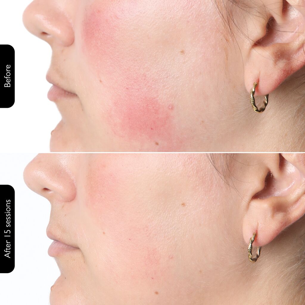 SILKN Facial LED Mask 100