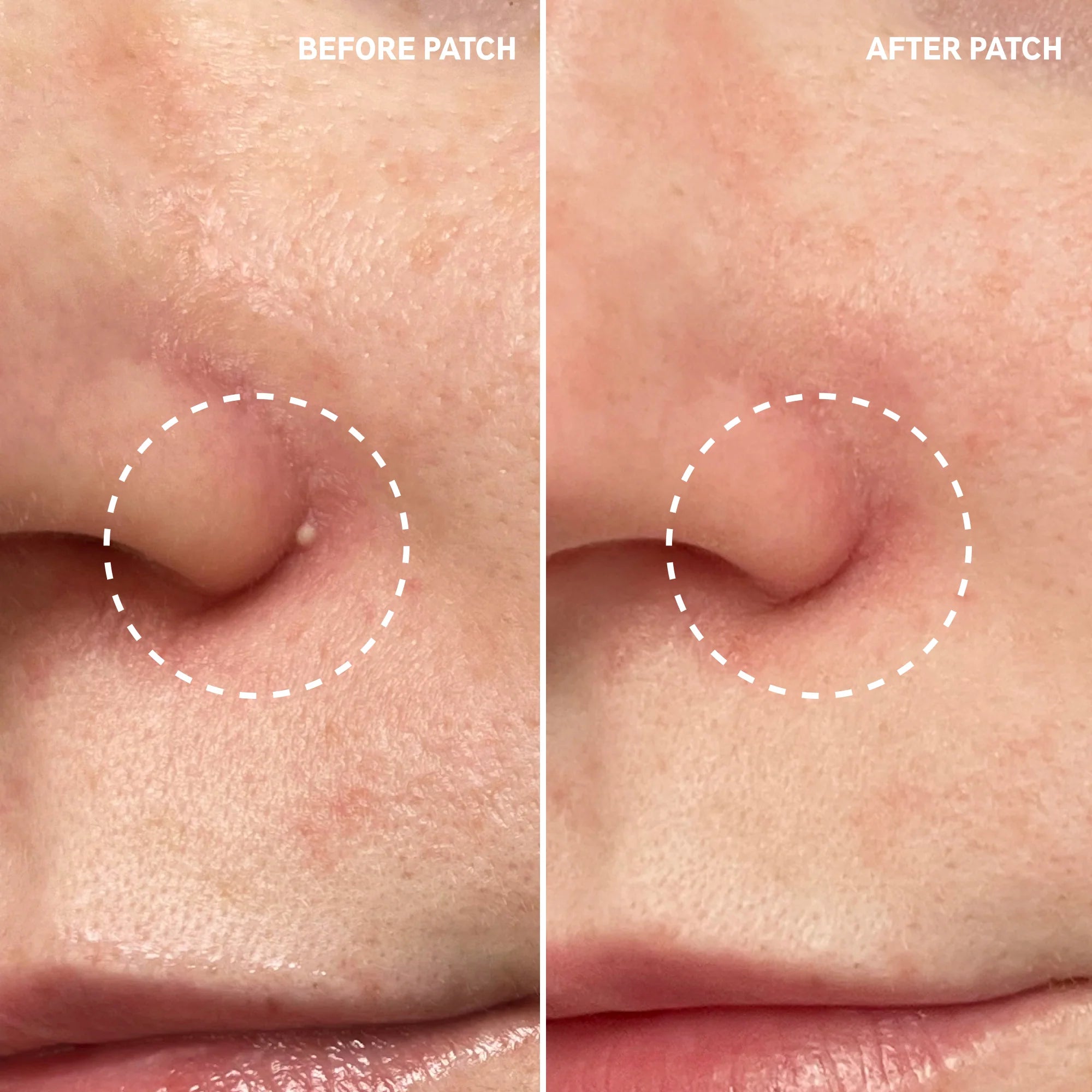 The INKEY List Hydrocolloid Invisible Pimple Patches