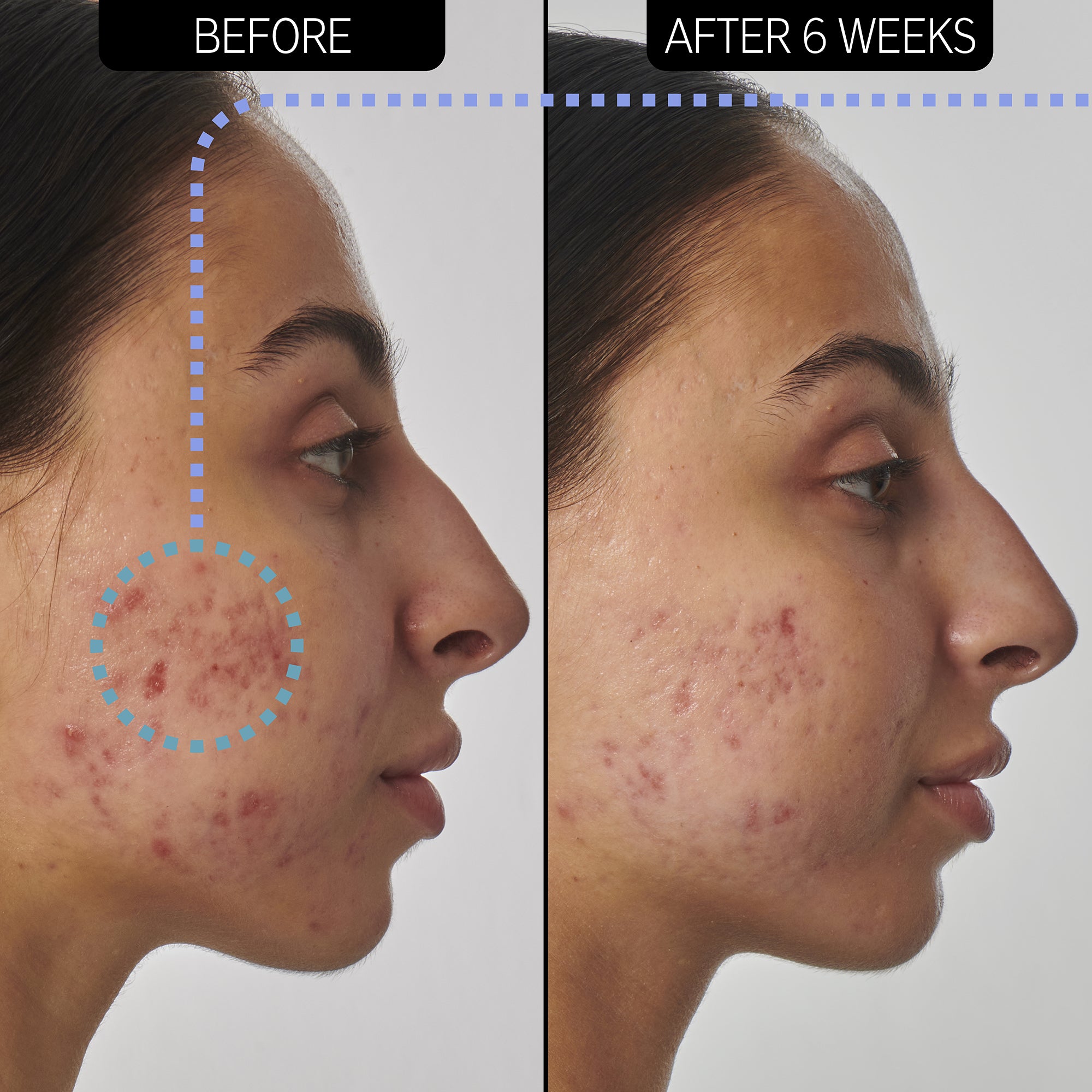 The Inkey List Scar, Mark and Wrinkle Solution - 1% Retinol Serum