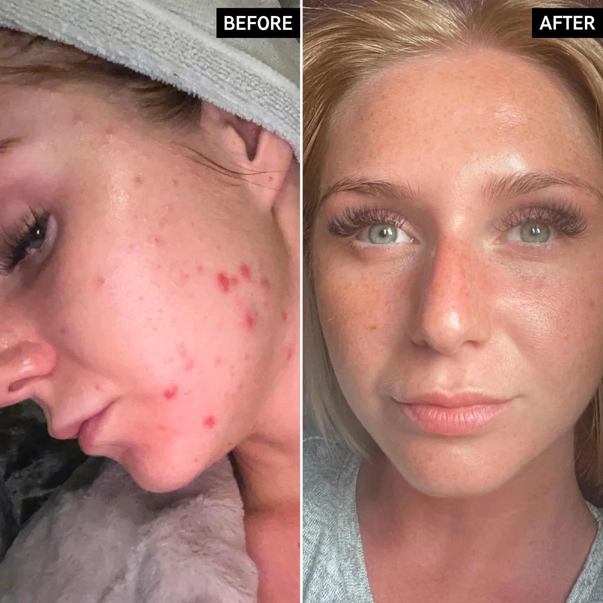 The Inkey List Beta Hydroxy Acid Serum
